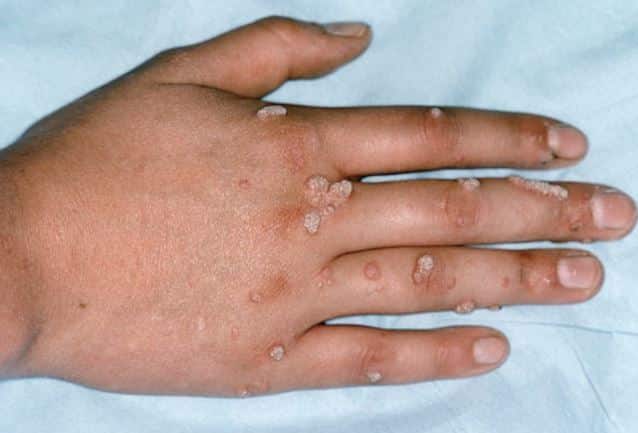 hpv warzen an der hand