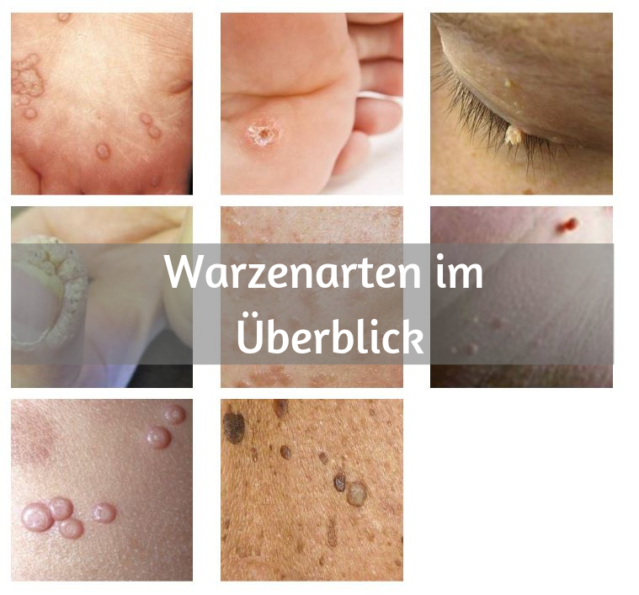 Warzenarten Übersicht, Merkmale & Behandlungsmöglichkeiten