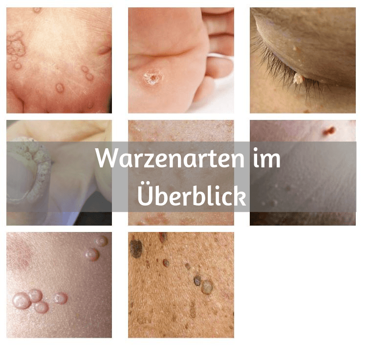 Warzenarten im Ueberblick 