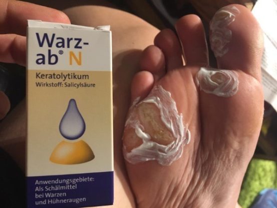 Mittel Gegen Warzen Am Fuß www.warzen-hilfe.com